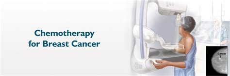 Tiba ya Kemia kwa Saratani ya Matiti: Hatua, Dalili, na Madhara