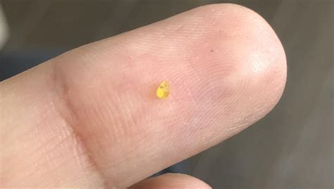 My chin keeps making these tiny yellow crystals. wtf are they? : r/acne