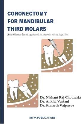CORONECTOMY FOR MANDIBULAR THIRD MOLARS: Buy CORONECTOMY FOR MANDIBULAR ...