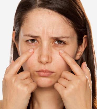 How to get rid of dark circles naturally