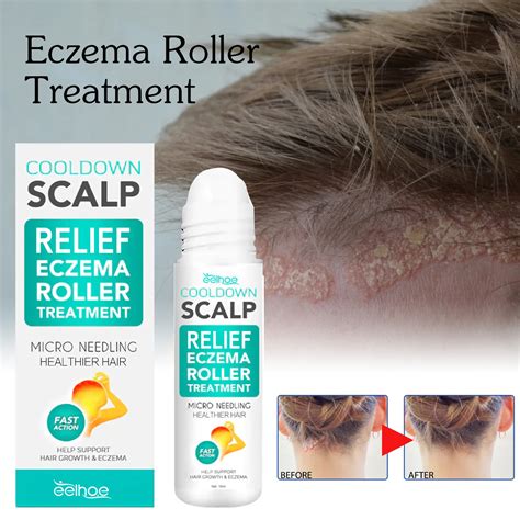 Eczema Scalp Treatment