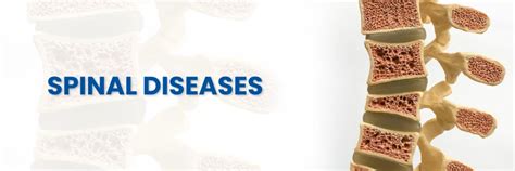 Ocho tipos de enfermedades espinales comunes y degenerativas
