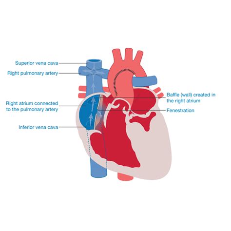 Double Inlet Left Ventricle (DILV) | Little Hearts Matter