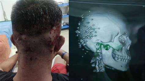 “I am injured but not scared” told the 17 year old boy with more than ...