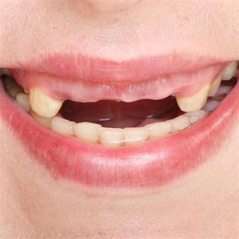 Image result for Bottom Front Teeth Partials