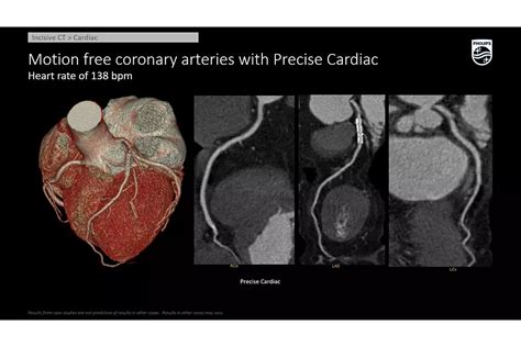 Incisive CT - Philips