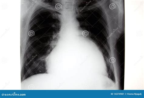Chest X Ray Heart Borders at Tami Smith blog