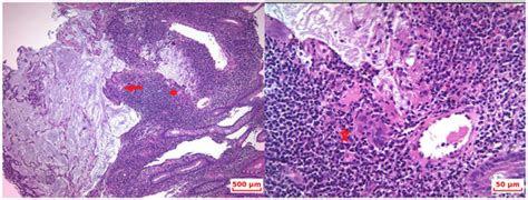 High-Grade Appendiceal Goblet Cell Adenocarcinoma—A Literature Review ...