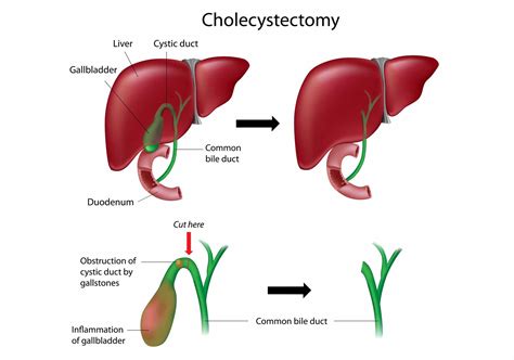 Gallbladder Surgery in Katy, TX | Dr. Clay Albrecht