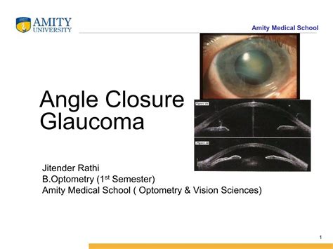 Angle Closure Glaucoma | PPT