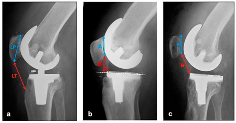 Patellar Tracking in Total Knee Arthroplasty—Influence on Clinical and ...