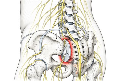 Pinched Nerve Lower Back