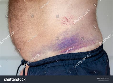 Abdominal Bruising