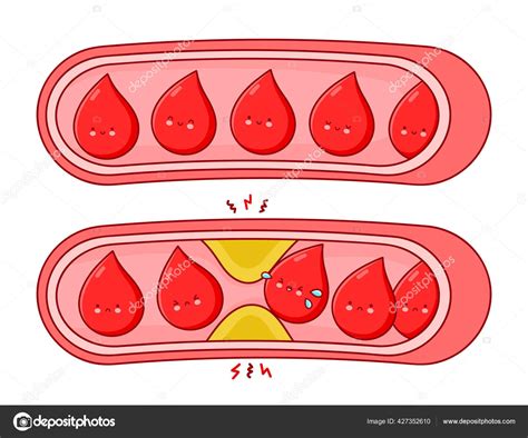 Normal and clogged blood vessels Stock Vector by ©Kahovsky 427352610