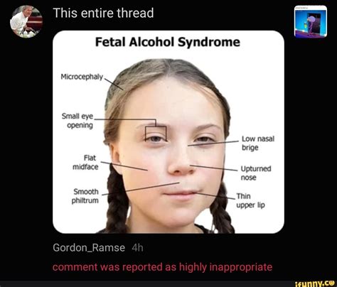 Fetal Alcohol Syndrome Microcephaly a f Small eye opening - iFunny