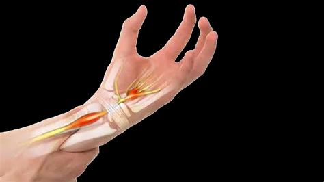 Carpal Tunnel In Spanish Definition at Jennifer Carranza blog
