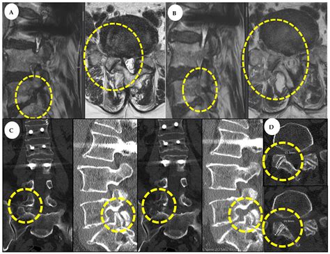 Biportal Endoscopic Decompression with Maximized Facet Joint ...