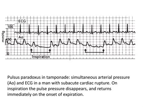 Pericardial Tamponade | PPTX