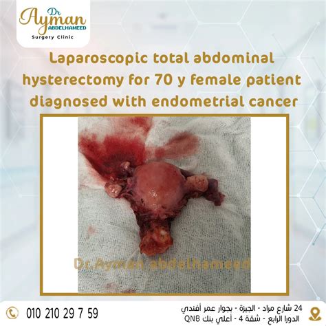 Laparoscopic total abdominal hysterectomy - Dr.Ayman Abd Elha