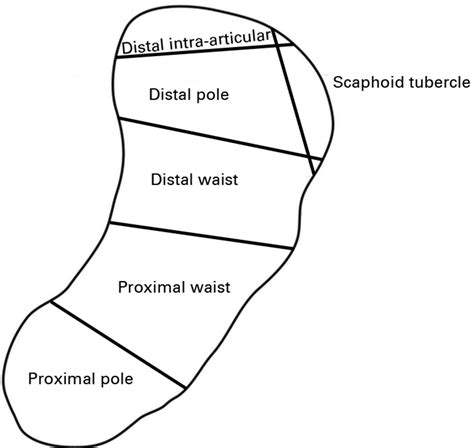 The epidemiology of fractures of the scaphoid | Bone & Joint