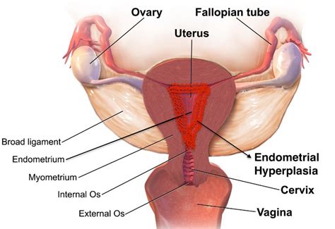 Image result for Hyperplastic Endometrium