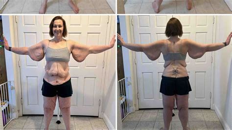 Fundraiser by Tori Friess Phillips : Excess skin removal surgery