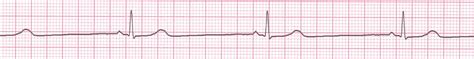 Arrhythmias