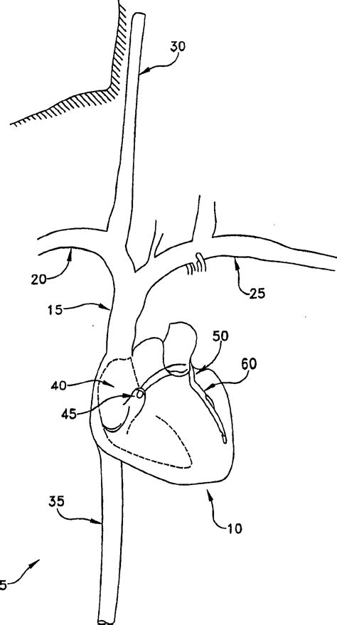 Method and apparatus for improving mitral valve function - Eureka | Patsnap