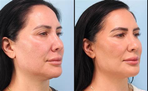 Image result for Thread Lift Problems