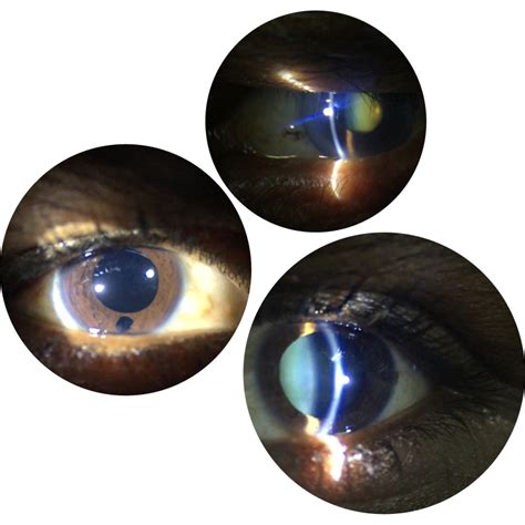 Remidio PSL D20 | Hand Held Portable Slit Lamp