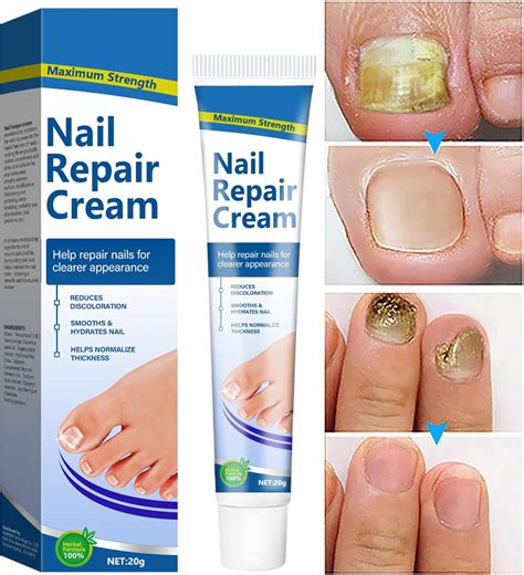 Fungal Nail Treatment Cream - Antifungal Cream Nail Fungus Treatment ...