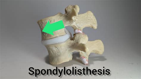 Spondylolisthesis L2-3 Grade 1: Understanding Anterolisthesis in Spine ...
