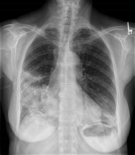 Popcorn Lung Picture