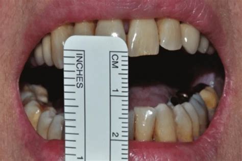 Oral submucous fibrosis | OSF treatment | Oral fibrosis specialists ...