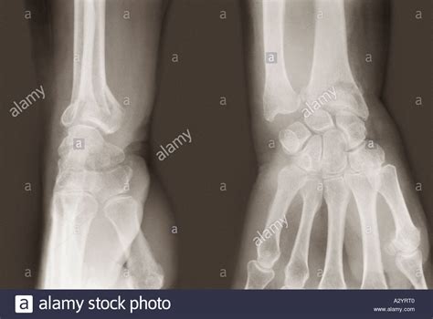 Image result for Fractured Radius