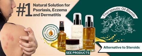 Amazon.in: Oleum Cottage: Scalp Psoriasis & Dermatitis