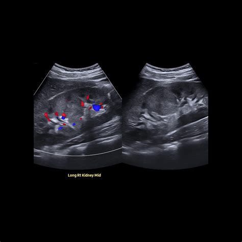 School ager with a solitary right kidney | Pediatric Radiology Case ...