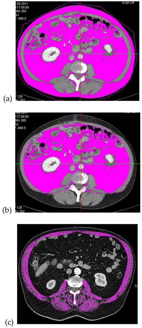 The Role of CT-Quantified Body Composition on Longitudinal Health ...