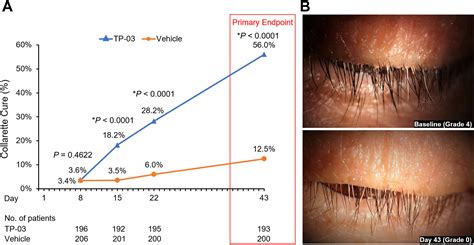 Lotilaner Ophthalmic Solution 0.25% for Demodex Blepharitis - Ophthalmology