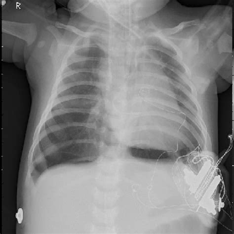 Classification Of Pneumonia