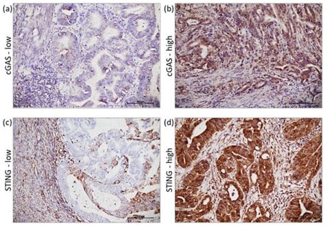 Activation of cGAS-STING Pathway Is Associated with MSI-H Stage IV ...