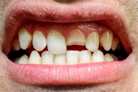 Image result for Broken Toothpick