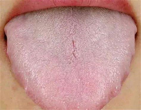 【艾养身】舌头有齿痕多为气虚！让艾灸帮你做好入冬准备！—【NMN观察】