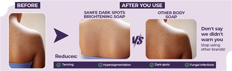 Buy Sanfe Dark Spots Brightening Skin Lightening Soap | 2% Kojic Acid ...