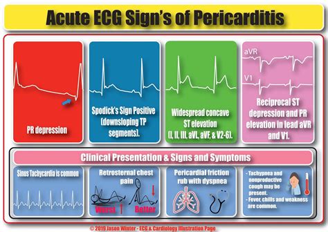 Pericarditis And Ecg