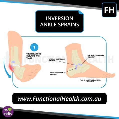 Inversion Ankle Sprain - Functional Health Physiotherapy ...