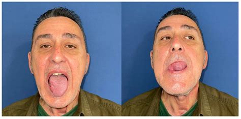 Functional Outcomes with Facial Artery Musculo-Mucosal (FAMM) Flap and ...