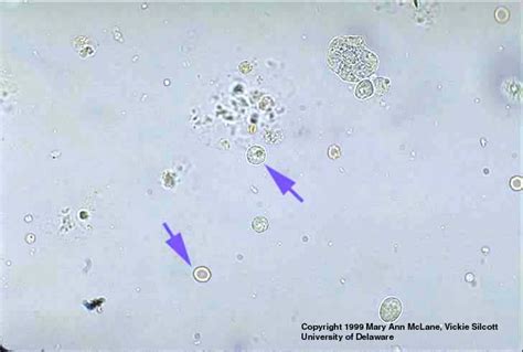 leukocytes in urine but no infection