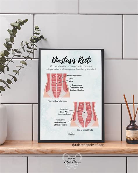 Diastasis Recti Pelvic Floor Art Poster | Postpartum, Pregnancy, Pelvi – Raise The Pelvic Floor