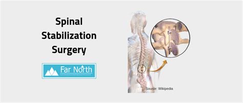 Image result for Spinal Stabilization Recovery